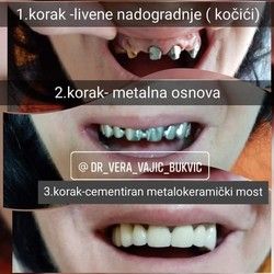 Krunice za zube povoljno cena