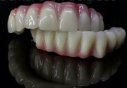 Bazalni zubni implanti