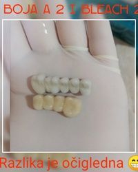 Krunice za zube