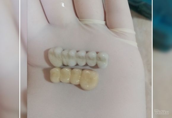 Krunice za zube