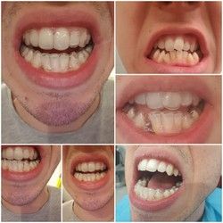 Ispravljanje zuba FOLIJAMA