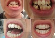 Folije za ispeavljanje zuba