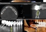 3D snimanje zuba CBCT
