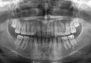 Ortopan - digitalni snimak zuba