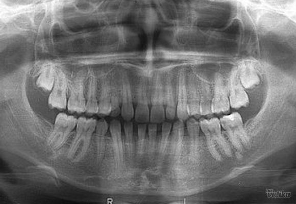 Ortopan - digitalni snimak zuba