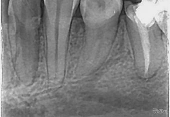 Mali snimak pojedinacnog zuba