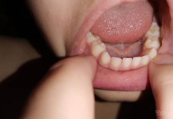 Mlečni zubi