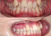 Ortodonstka terapija