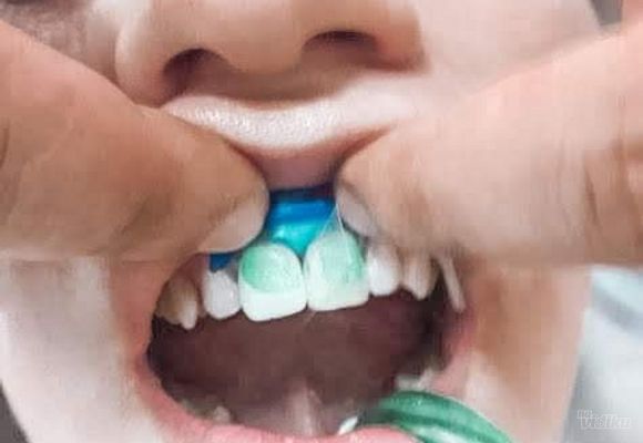 Bele mrlje na zubima