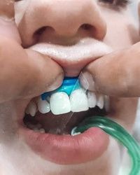 Bele mrlje na zubima
