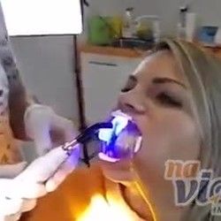 Izbeljivanje zuba