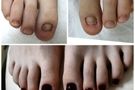 Protetika nokta