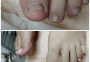 Estetski pedikir i protetika nokta na palčevima