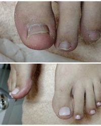 Estetski pedikir i protetika nokta na palčevima