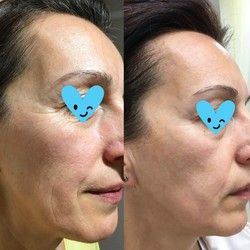 Nehirusko zatezanje lica