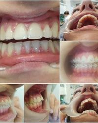 Estetska fiksna proteza za zube