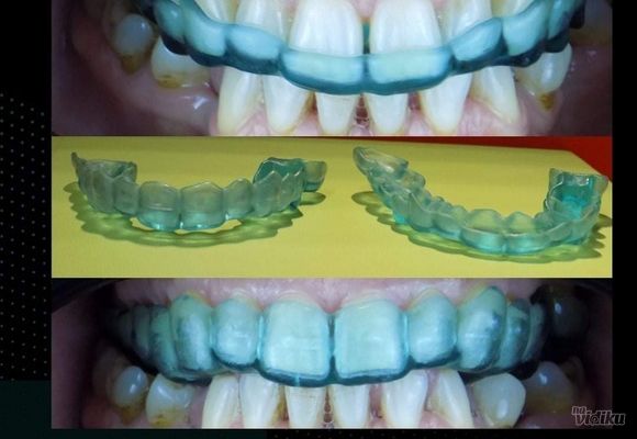 Škripanje zubima - bruksizam