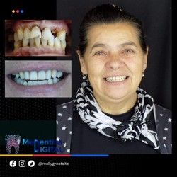 Zubne proteze