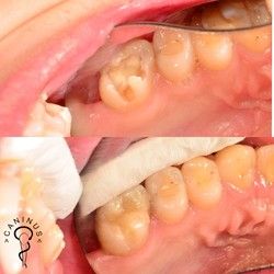 Plombiranje zuba, zubar zarkovo, popravka zuba