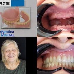 Totalne zubne proteze