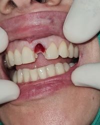 Cirkon krunica na implantu
