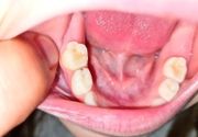 Lečenje zuba kod dece. Dečija stomatologija. 