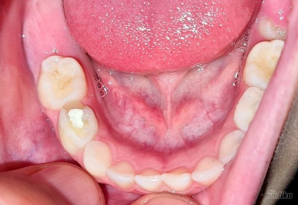 Lečenje zuba kod dece. Dečija stomatologija. 