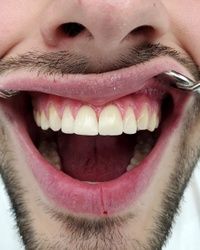 Atricija i nepravilnosti oblika zuba
