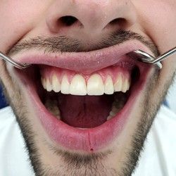 Atricija i nepravilnosti oblika zuba