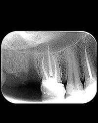Mašinska endodoncija 