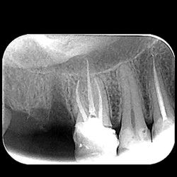 Mašinska endodoncija 
