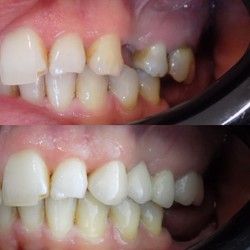 Da li gubitak jednog zuba može da utiče na ostale?