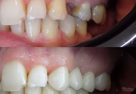 Da li gubitak jednog zuba može da utiče na ostale?