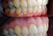 Cirkonijum zubne krunice 