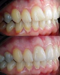 Cirkonijum zubne krunice 