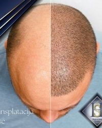 Transplatacije kose Sapphire FUE hair transplant
