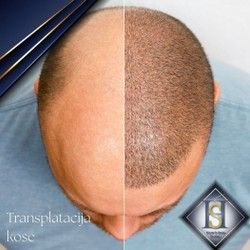 Transplatacije kose Sapphire FUE hair transplant