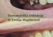 Navlake - krunice za zube Medaković 