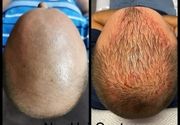 Lecenje alopecije