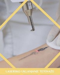 Lasersko uklanjanje tetovaža