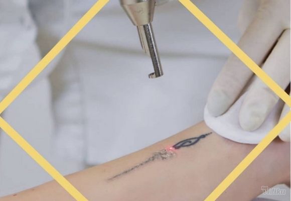 Lasersko uklanjanje tetovaža