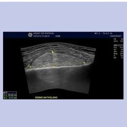 Sremcica ultrazvuk mekih tkiva