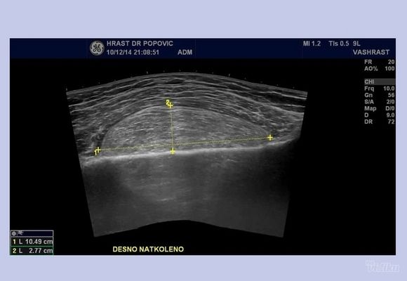 Sremcica ultrazvuk mekih tkiva