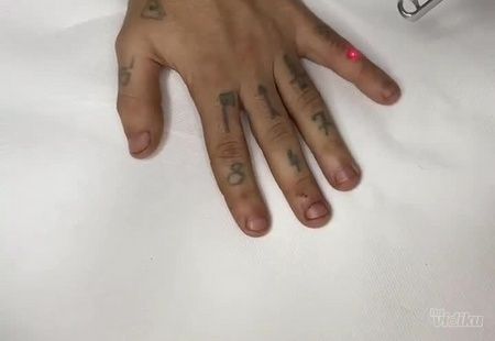 Uklanjanje tetovaža laser tehnikom