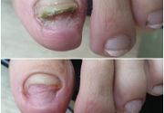 Sredjivanje gljivicnih noktiju