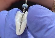 Lečenje kanala korena zuba
