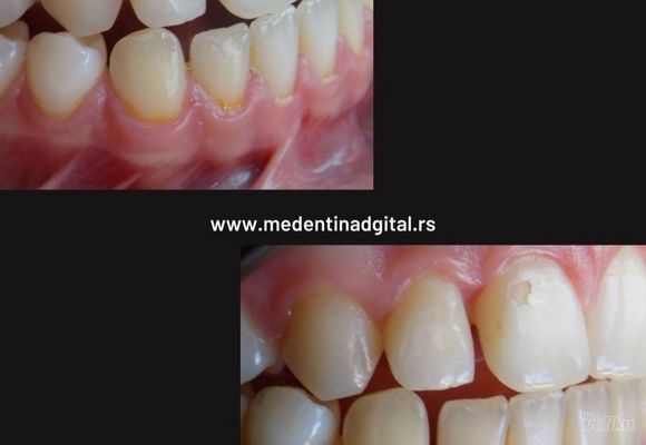 Gingivitis i parodontopatija 