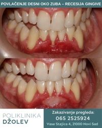 Povlačenje desni oko zuba Novi Sad