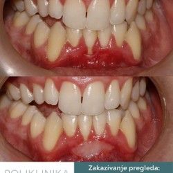 Povlačenje desni oko zuba Novi Sad