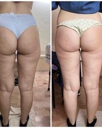 Masaza na kucnoj adresi/brazilska maderoterapija